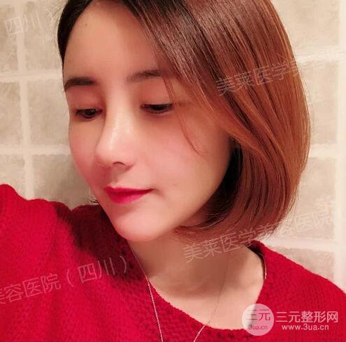 牛永敢醫(yī)生隆鼻案例術(shù)后恢復(fù)記錄詳情