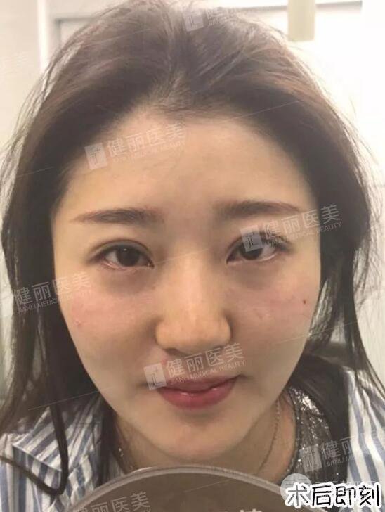 深圳健麗微創(chuàng)去眼袋+眶隔脂肪轉移術前后對比果圖分享！