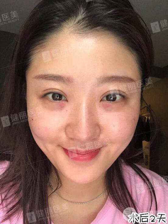 深圳健麗微創(chuàng)去眼袋+眶隔脂肪轉移術前后對比果圖分享！