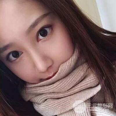 硅膠假體隆鼻案例前后對(duì)比圖分享！顏值變化驚人！