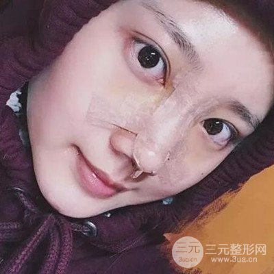 硅膠假體隆鼻案例前后對(duì)比圖分享！顏值變化驚人！