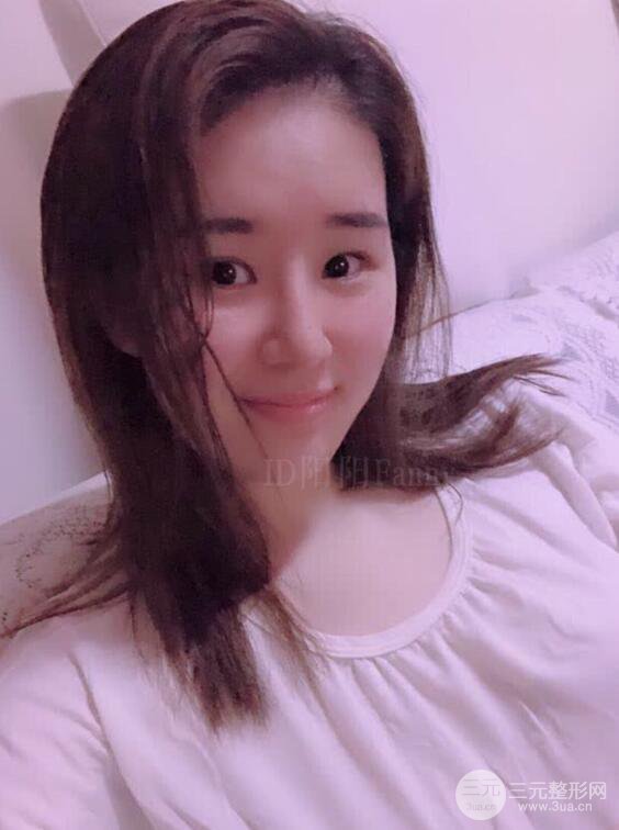 上海華美李庭勛假體隆鼻前后對比圖一個月恢復(fù)心情日記