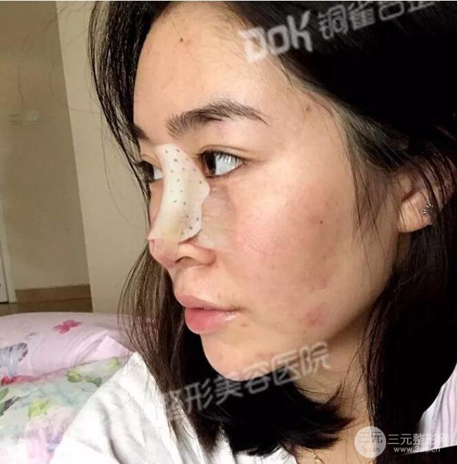 重慶銅雀臺假體隆鼻前后對比圖案例分享!