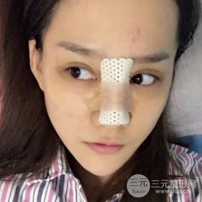 廣州韓妃李光琴隆鼻失敗修復(fù)前后對比圖分享！