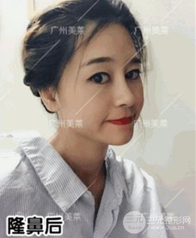 廣州美萊自體軟骨隆鼻案例前后對(duì)比圖分享!