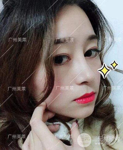 廣州美萊自體軟骨隆鼻案例前后對(duì)比圖分享!