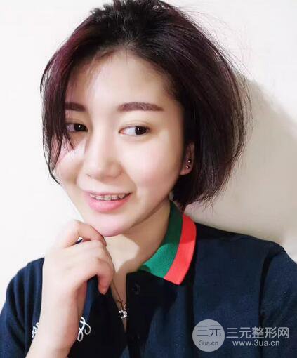 北京大學(xué)口腔醫(yī)院牙齒矯正案例詳情