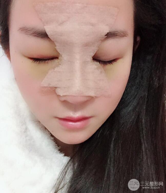 杭州華山連天美高俊明假體隆鼻術(shù)前術(shù)后對比圖 兩個(gè)月恢復(fù)心情