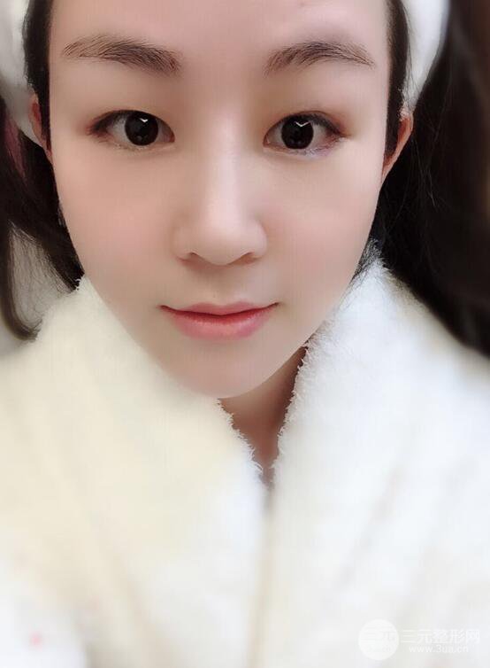 杭州華山連天美高俊明假體隆鼻術(shù)前術(shù)后對比圖 兩個(gè)月恢復(fù)心情