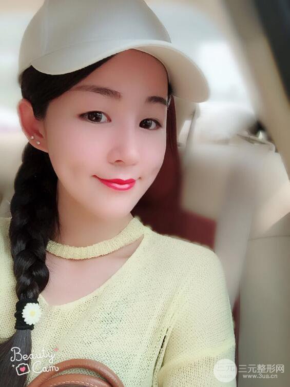 杭州華山連天美高俊明假體隆鼻術(shù)前術(shù)后對比圖 兩個(gè)月恢復(fù)心情