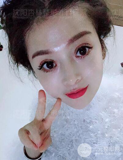 沈陽杏林朱石江隆鼻隆鼻整形案例手術(shù)過程記錄