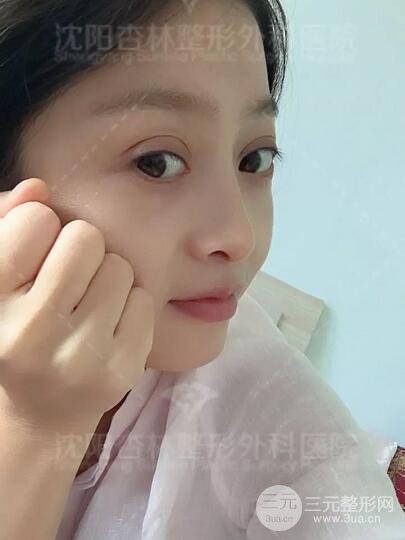 沈陽杏林朱石江隆鼻隆鼻整形案例手術(shù)過程記錄