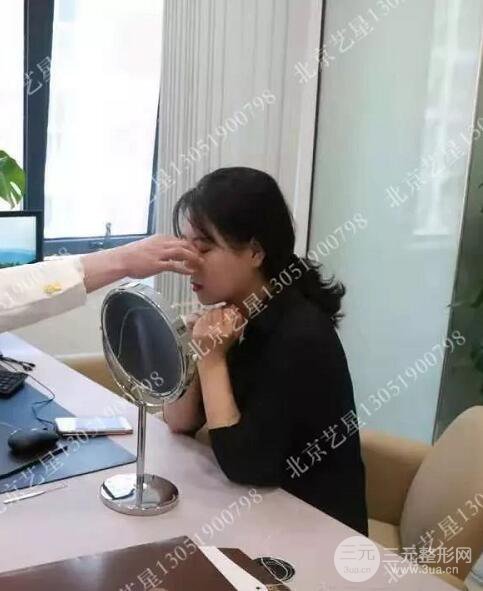 北京藝星仇侃敏微創(chuàng)肋軟骨隆鼻前后對比圖 術后一個月的恢復狀況