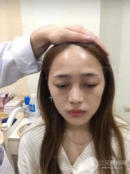 重慶愛思特整形隆鼻案例術(shù)后恢復(fù)果分享！