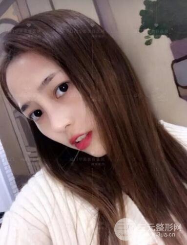 重慶愛思特整形隆鼻案例術(shù)后恢復(fù)果分享！