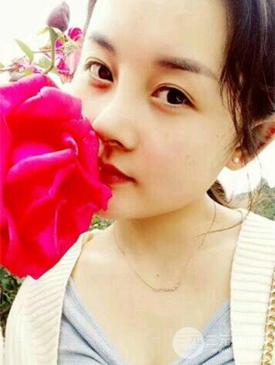 成都艾美薇魏東隆鼻整形手術(shù)前后恢復(fù)果圖分享