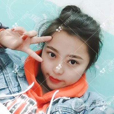 廣州韓妃全切雙眼皮案例日記分享~