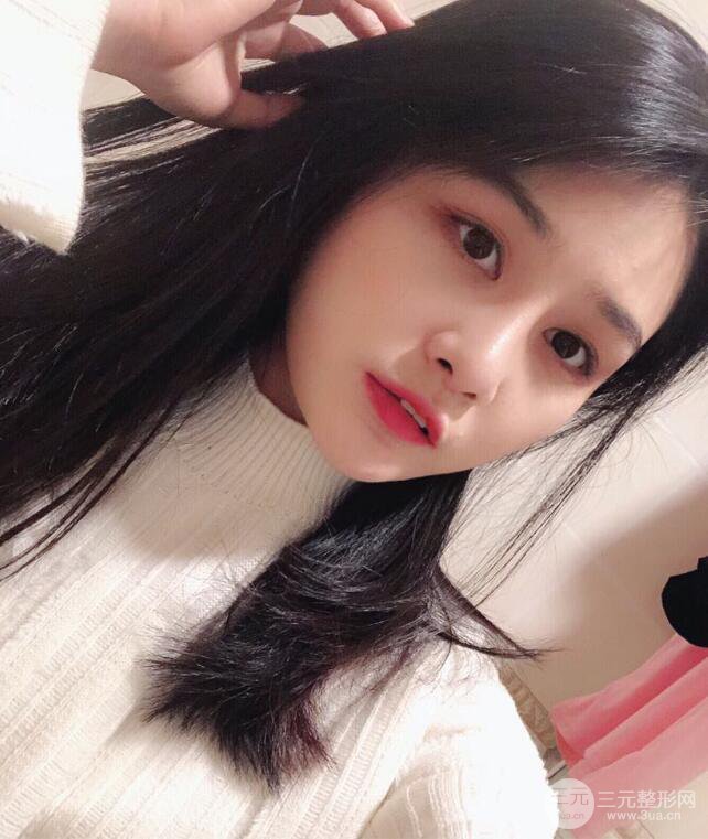 蘇州紫馨顧陸健韓式隆鼻前后對(duì)比圖|真人案例心情日記