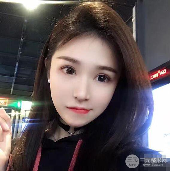 延吉金光善眼部整形失敗修復(fù)前后對(duì)比圖 三個(gè)月恢復(fù)自然