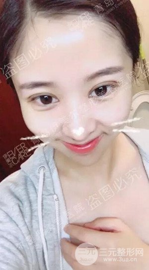 青島伊美爾5s重瞼術(shù)日記分享