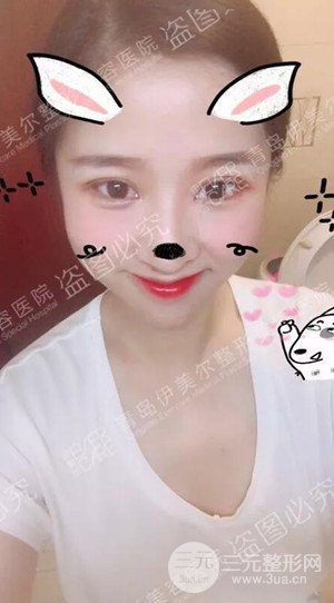 青島伊美爾5s重瞼術(shù)日記分享