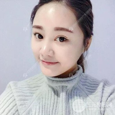 沈陽百嘉麗汪曉蕾自體脂肪面部填充恢復(fù)記錄案例分享~