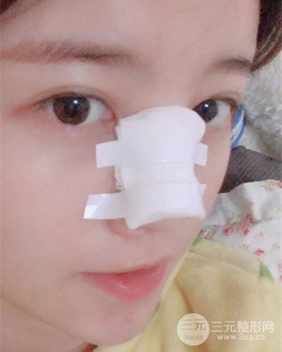 成都天使之翼金輝假體隆鼻案例前后對比圖分享~