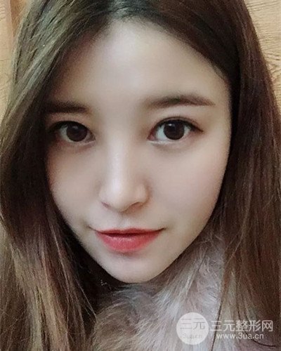 成都天使之翼金輝假體隆鼻案例前后對比圖分享~