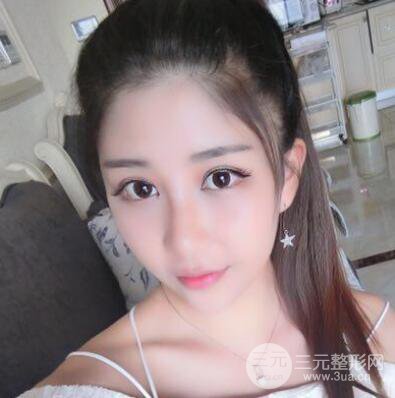 沈陽軍區(qū)總醫(yī)院時(shí)杰切開雙眼皮案例對比圖|內(nèi)附心情恢復(fù)小札哦