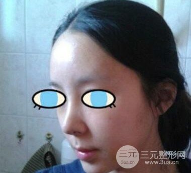 杭州華山連天美膨體隆鼻日記前后對比圖分享~