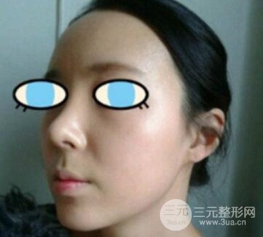 杭州華山連天美膨體隆鼻日記前后對比圖分享~