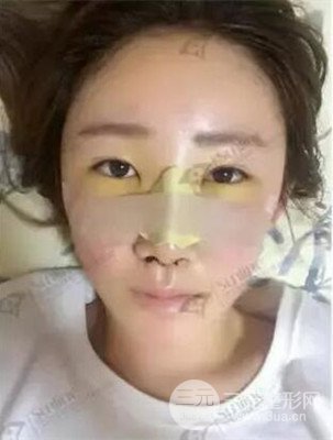 沈陽杏林史靈芝醫(yī)生隆鼻整形案例日記分享~