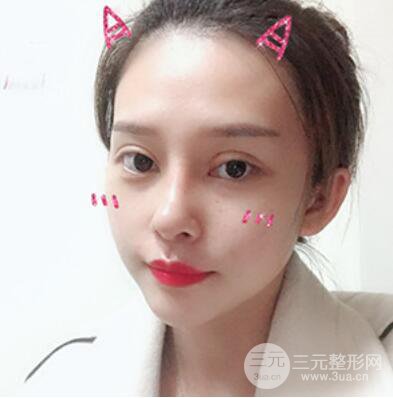 哈美萊鄭東學(xué)隆鼻整形案例對(duì)比圖真實(shí)心情分享喲~