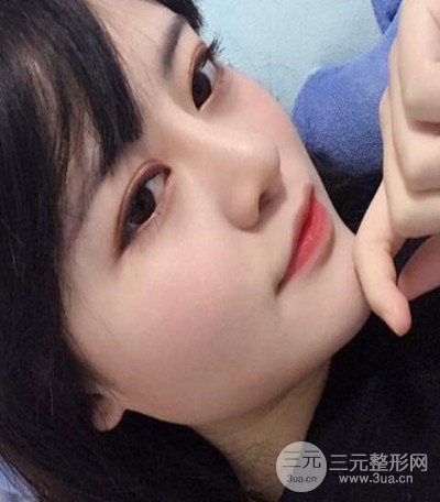 濟(jì)南韓氏郭廣科醫(yī)生隆鼻案例分享~