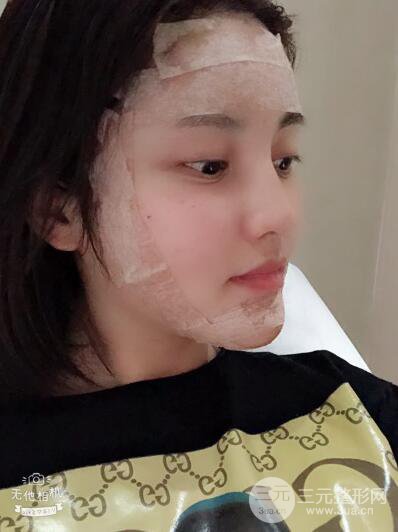 常州施爾美廉鋒自體脂肪豐臉對照圖案例心情日扎