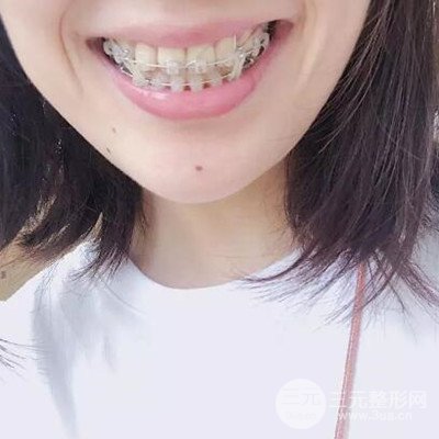 成都格林口腔唐建忠牙齒矯正案例前后對比圖分享~