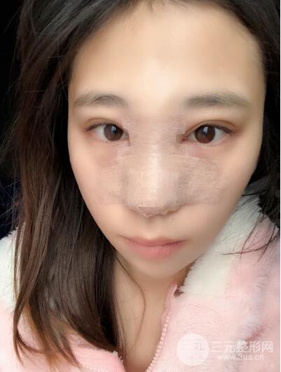 貴陽麗都李觀龍隆鼻整形案例對照圖一個月恢復(fù)過程分享