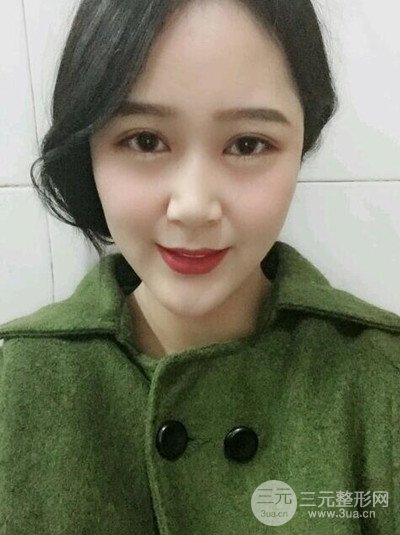 四川友誼李萍醫(yī)生假體墊下巴前后對(duì)比果圖片分享~