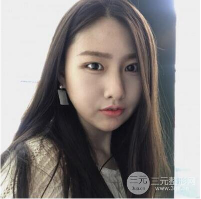 西安葉子魯禮新埋線雙眼皮案例對照圖!兩個月恢復(fù)心情小記