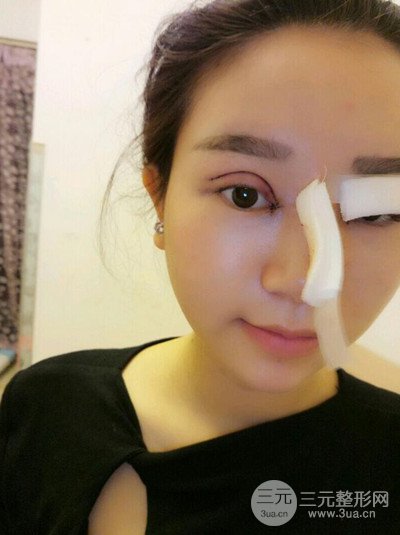 杭州藝之花楊海波全切雙眼皮一個月的恢復(fù)記錄分享~