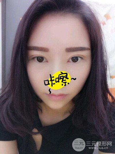 杭州藝之花楊海波全切雙眼皮一個月的恢復(fù)記錄分享~