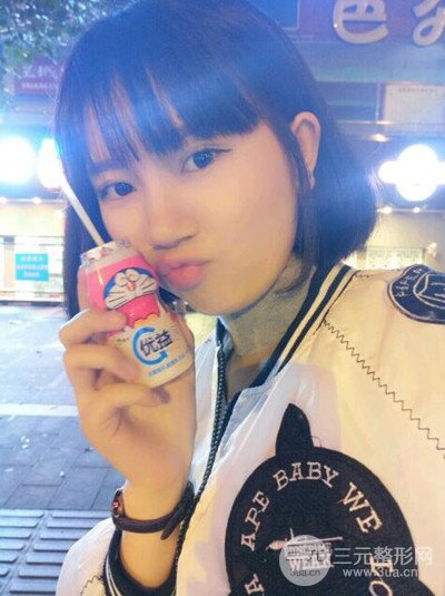 杭州藝之花楊海波全切雙眼皮一個月的恢復(fù)記錄分享~