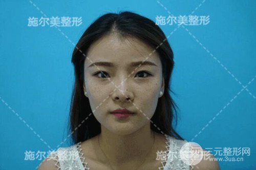 江蘇施爾美自體脂肪詳細(xì)部填充恢復(fù)記錄前后對(duì)比圖分享~