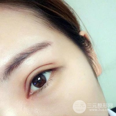 成都素美楊迪雙眼皮案例前后對比照分享~