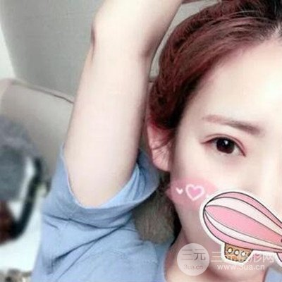 成都素美楊迪雙眼皮案例前后對比照分享~