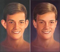 招風(fēng)耳矯正須知