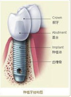 種植牙的簡介