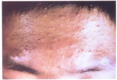 額部痤瘡示例圖