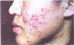 臉頰部痤瘡示例圖