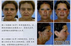 外在因素影響面部衰老